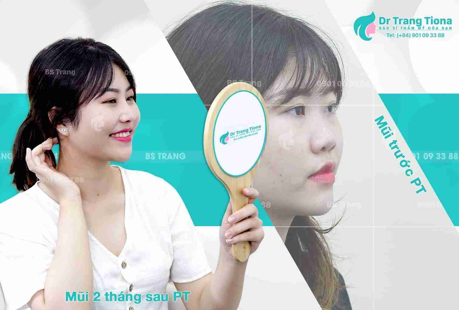 Nâng mũi cấu trúc bao lâu thì hết đau sưng đỏ?