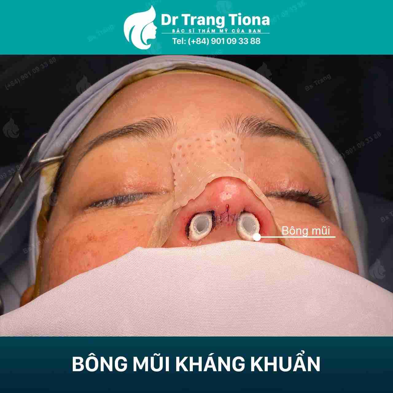 Vết khâu nâng mũi bị chảy dịch rỉ máu