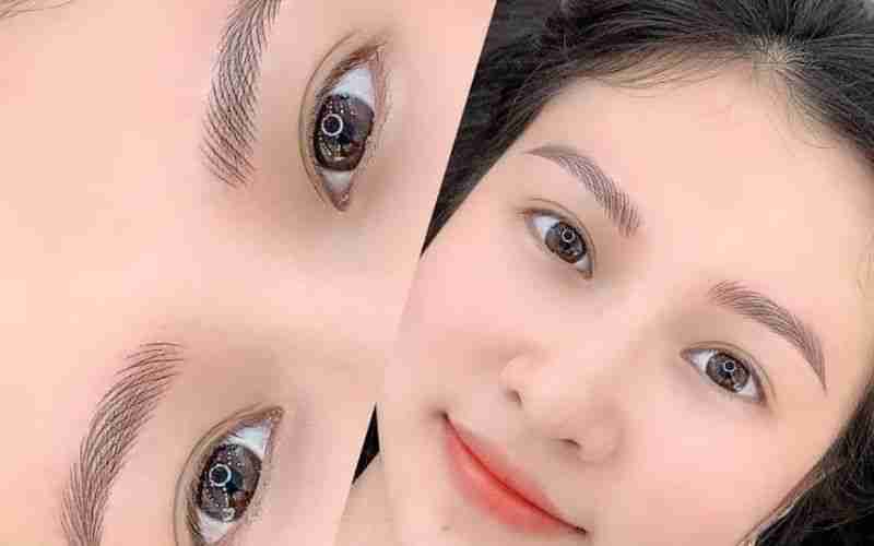 Sự thật việc cắt mí mắt để được vĩnh viễn