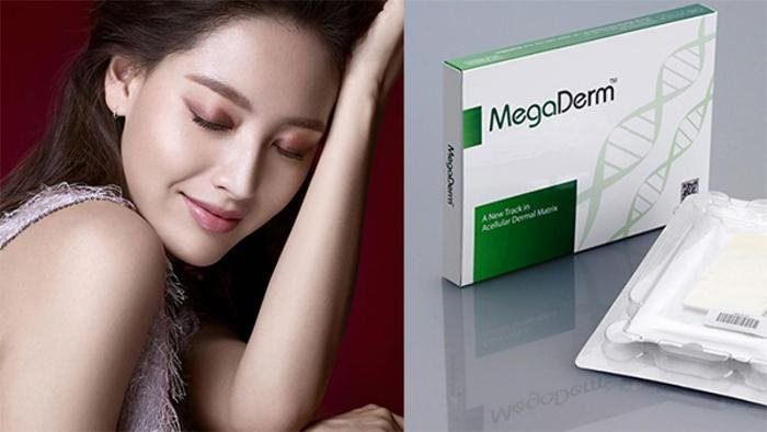 Tổng quan về phương pháp nâng mũi bọc sụn Megaderm