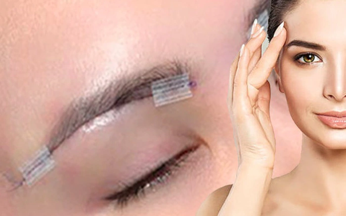 Treo cung chân mày – Giải pháp cho đôi mắt trẻ trung, to tròn