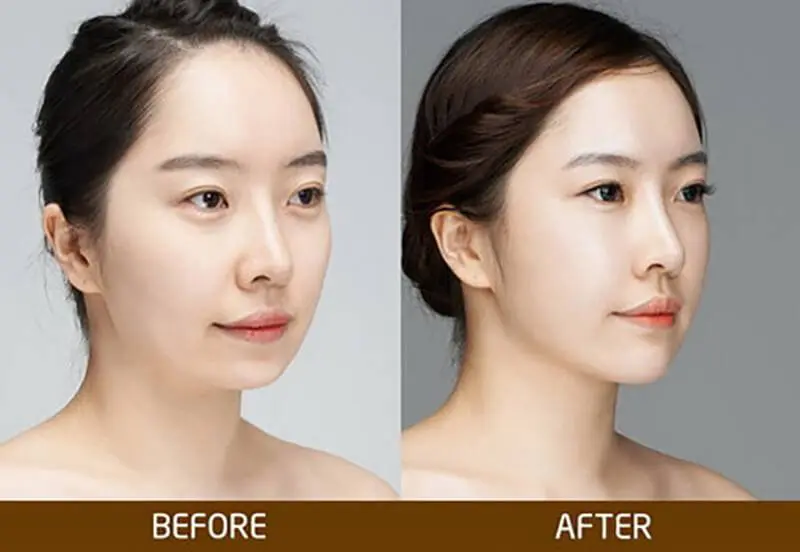 Độn cằm giá bao nhiêu