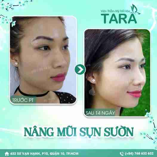 Nâng mũi sụn sườn ERAS 5i