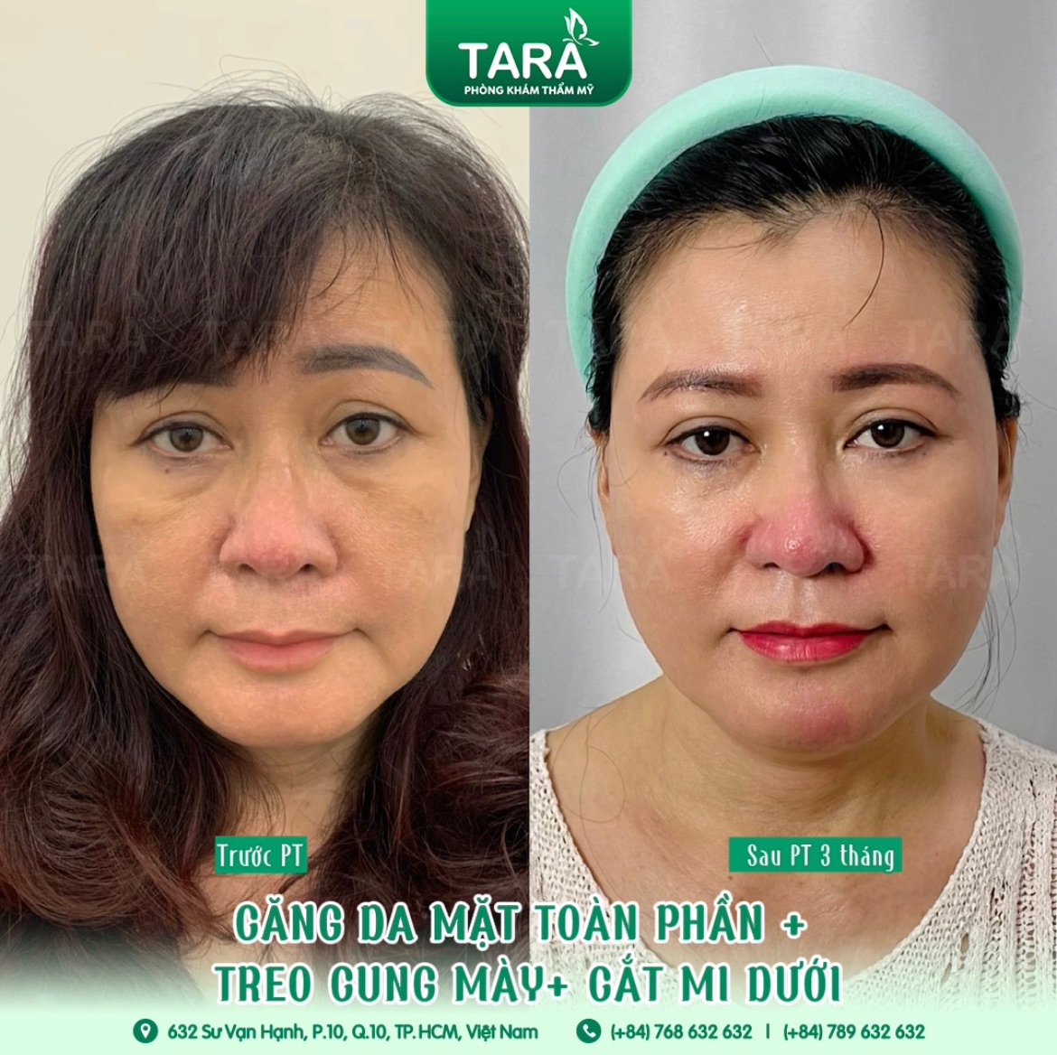 Căng da mặt đẹp tphcm