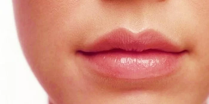 Phẫu thuật môi cười tự nhiên, không đau