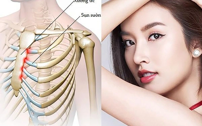Nâng mũi sụn sườn thực hiện như thế nào?