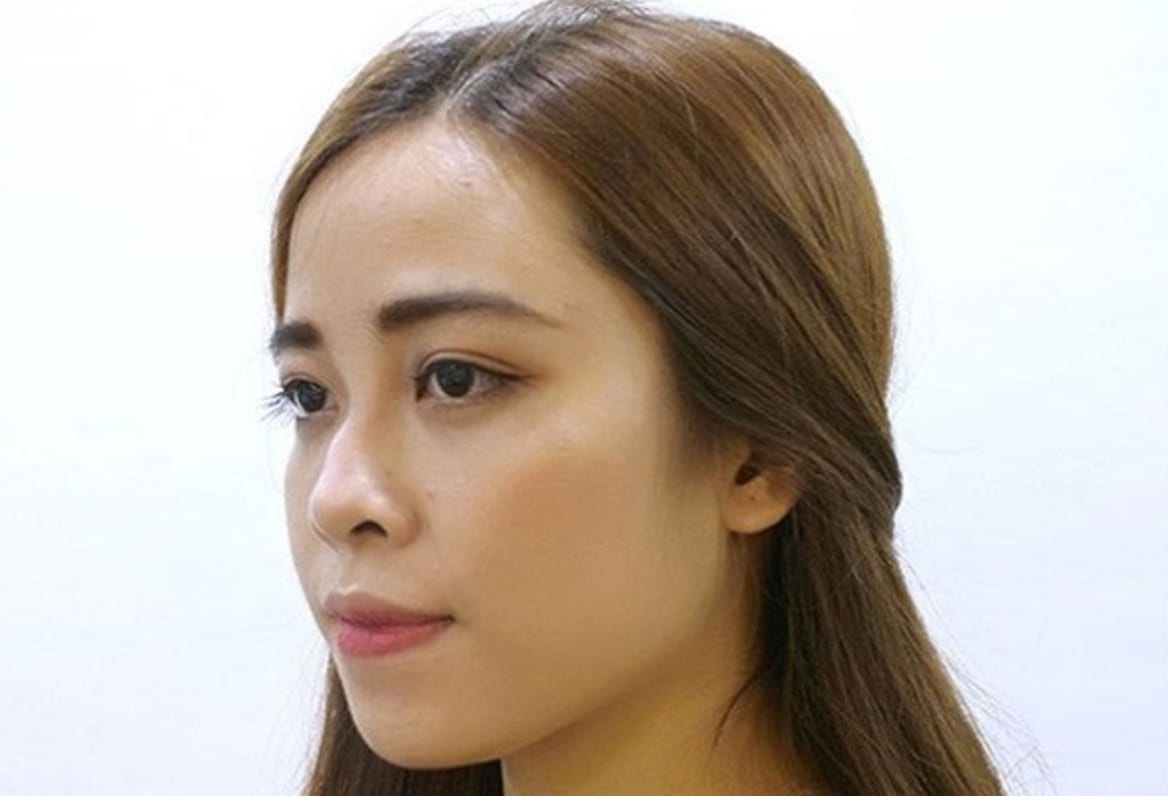 Giải pháp nâng mũi phù hợp cho người mũi gãy