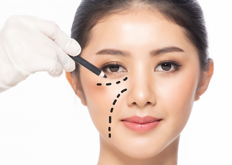 Vì sao căng da Midface là "liệu pháp trẻ hóa tầng giữa mặt 8 trong 1"?