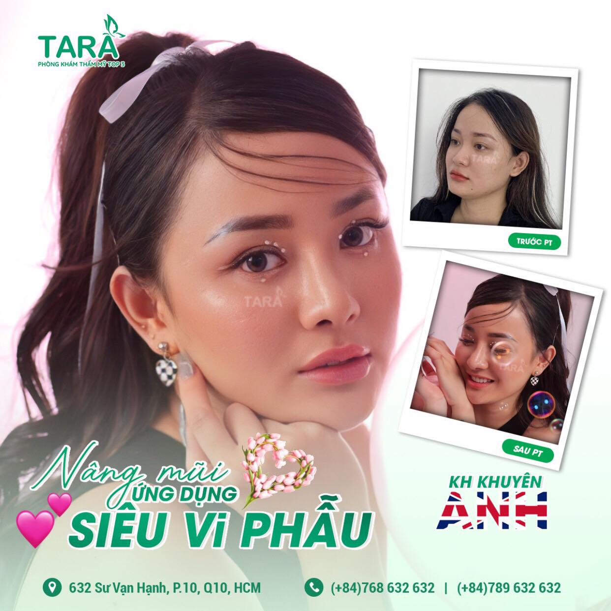 Vì sao nên đến TARA để nâng mũi siêu vi phẫu?