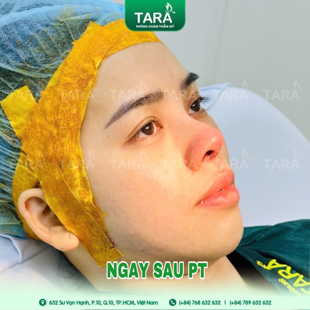 Cách chăm sóc sau nâng mũi siêu vi phẫu để có kết quả tốt nhất