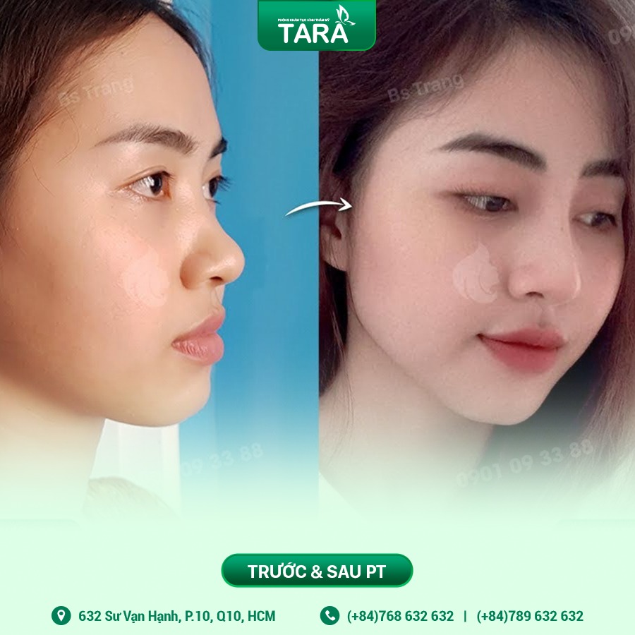 Chi phí nâng mũi siêu vi phẫu tại Bác sĩ Trang - Tara Clinic