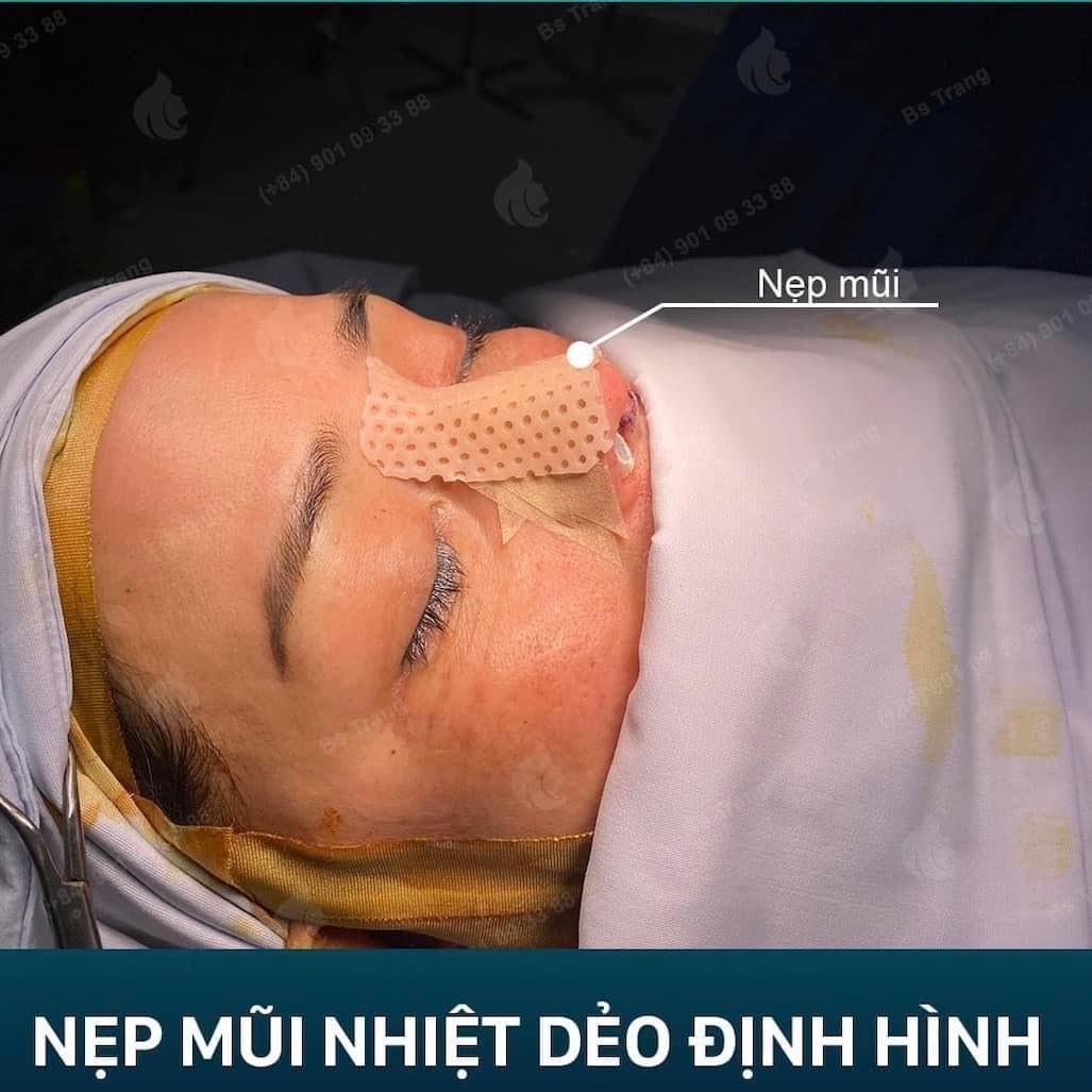 Tại sao cần nẹp cứng trong nâng mũi? Không có có sao không?