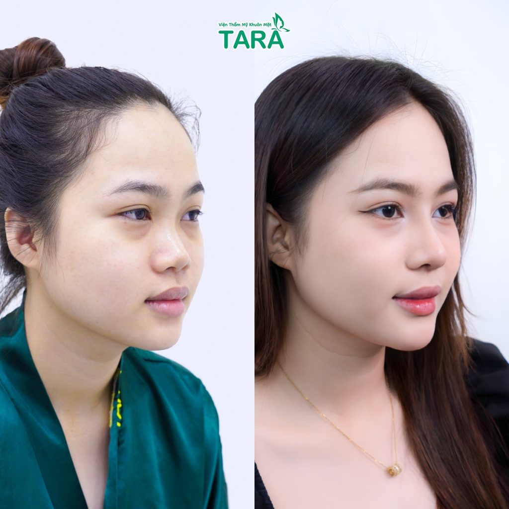 Nâng mũi siêu vi phẫu bao lâu thì lành và đẹp tự nhiên?
