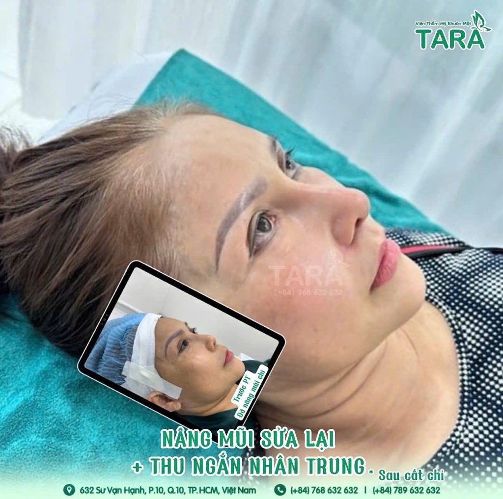 Nâng mũi siêu vi phẫu có sửa lại được không? Khi nào thì sửa được?