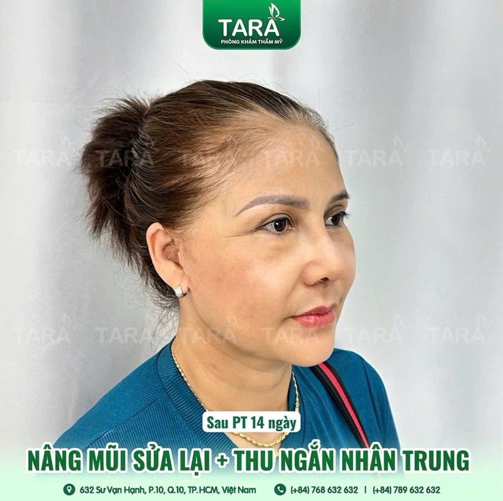 Nâng mũi siêu vi phẫu có sửa lại được không? Khi nào thì sửa được?