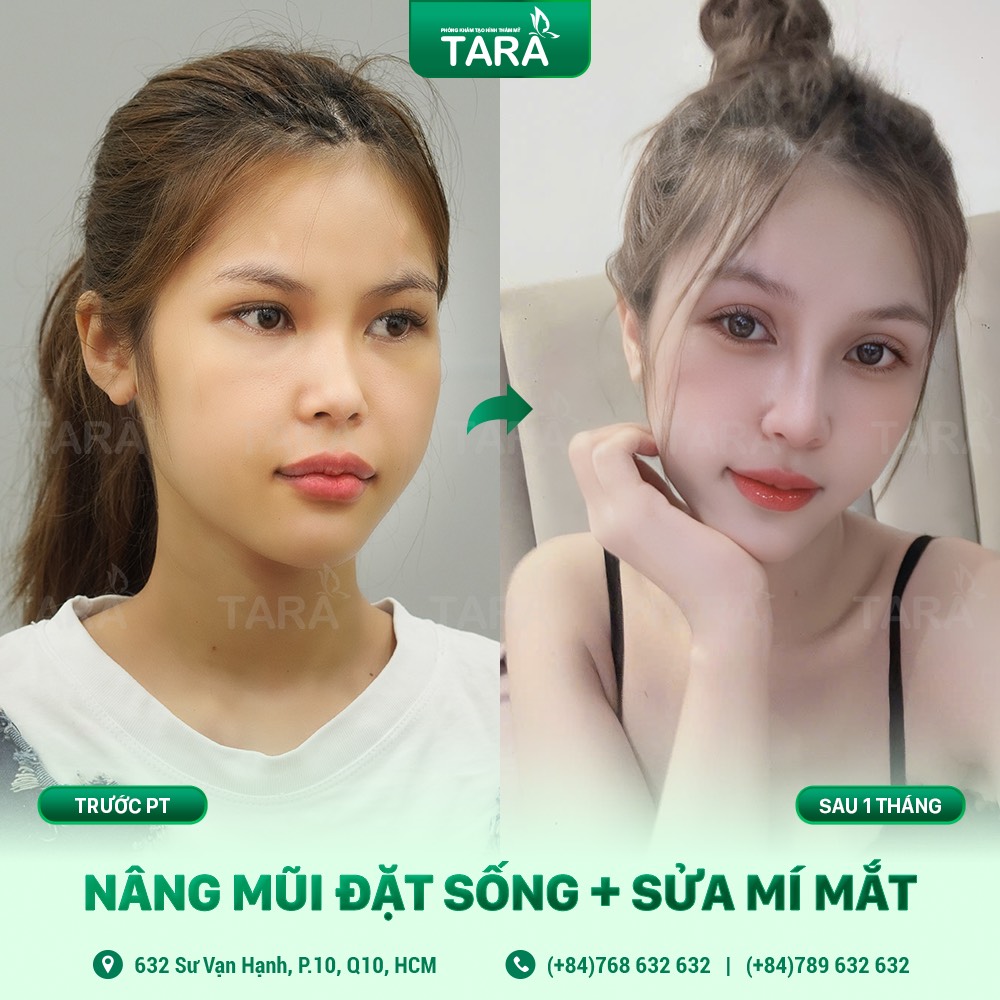 Có nên kết hợp nâng mũi và căng da mặt cùng lúc?