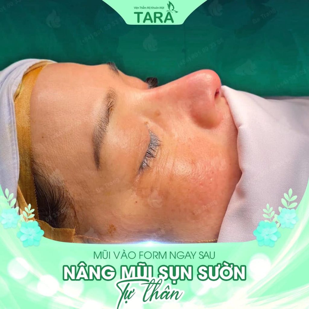 So sánh nâng mũi siêu vi phẫu với các phương pháp nâng mũi khác