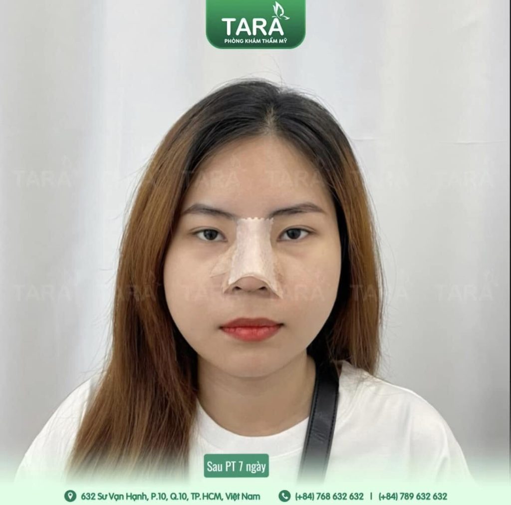 So sánh nâng mũi siêu vi phẫu với các phương pháp nâng mũi khác