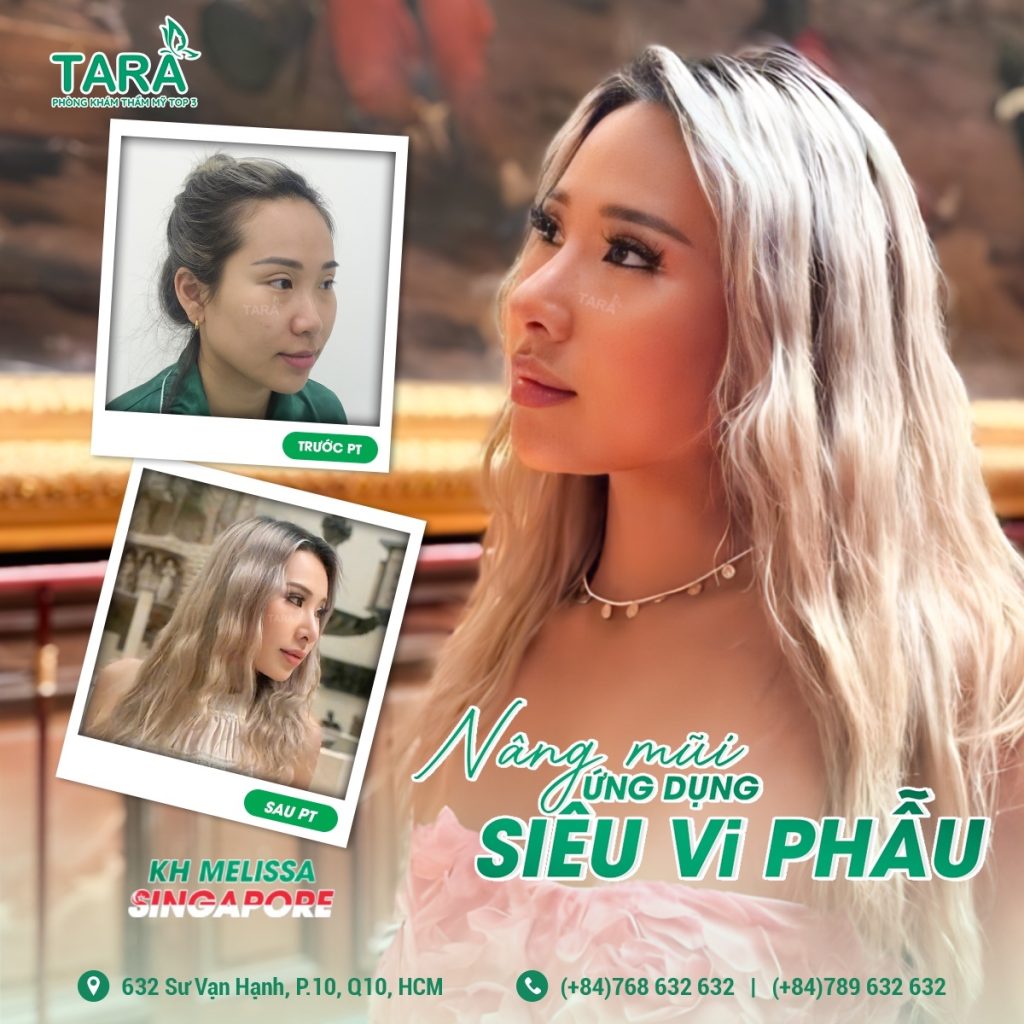 Nâng mũi siêu vi phẫu bằng sụn nhân tạo hiện đang là phương pháp thẩm mỹ được yêu thích bởi tính chính xác, an toàn và hiệu quả cao. Không chỉ giúp cải thiện dáng mũi trở nên hài hòa và tự nhiên, kỹ thuật này còn phù hợp với nhiều tình trạng mũi khác nhau nhờ sự đa dạng trong lựa chọn sụn nhân tạo.
Nếu bạn đang quan tâm đến dịch vụ nâng mũi, bài viết này sẽ cung cấp đầy đủ thông tin từ nâng mũi siêu vi phẫu là gì, các loại sụn nhân tạo phổ biến, đến cách lựa chọn phù hợp với từng dáng mũi.