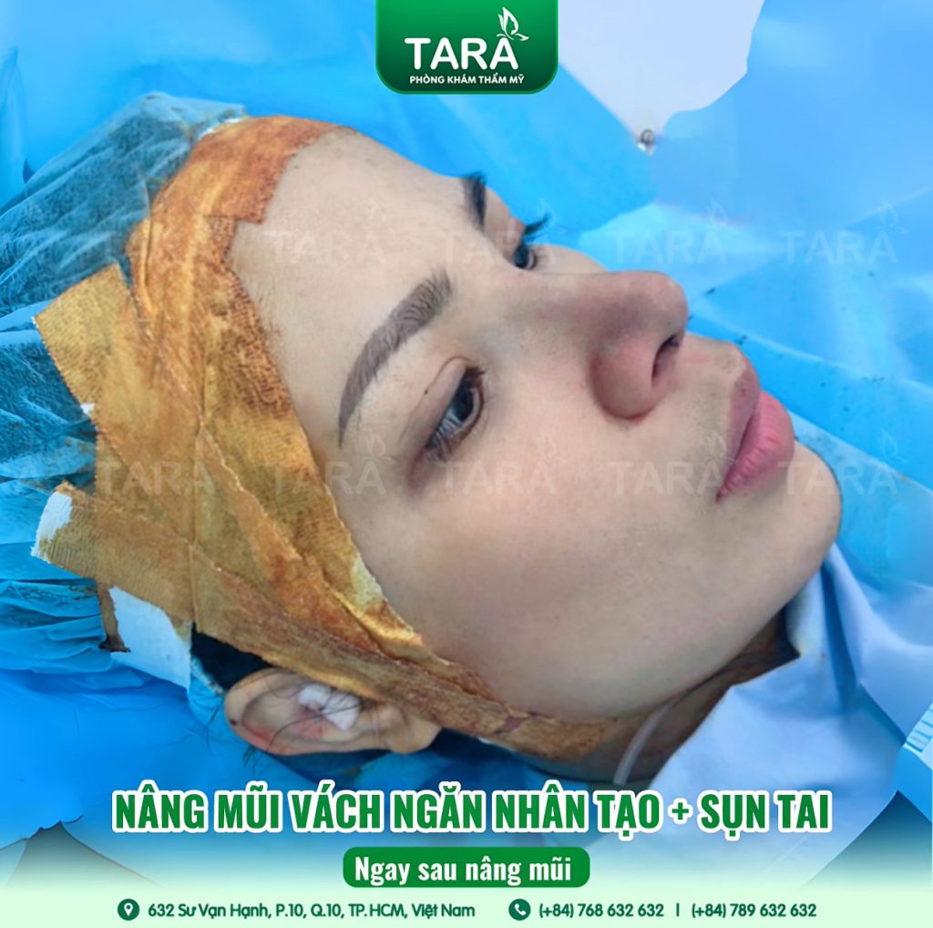 Nâng mũi siêu vi phẫu bằng sụn tự thân: Giải pháp tối ưu cho dáng mũi đẹp