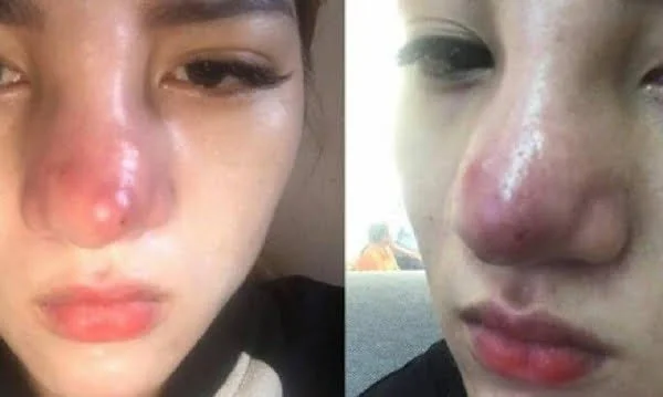 Nâng mũi siêu vi phẫu và những biến chứng có thể xảy ra