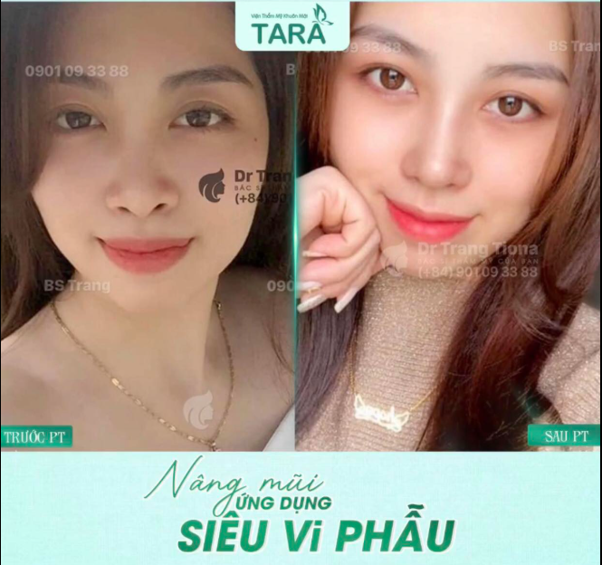Nâng mũi siêu vi phẫu: 7 lầm tưởng và sự thật thú vị