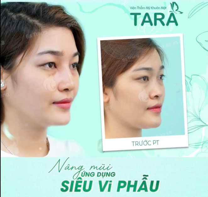 Nâng mũi siêu vi phẫu: 7 lầm tưởng và sự thật thú vị