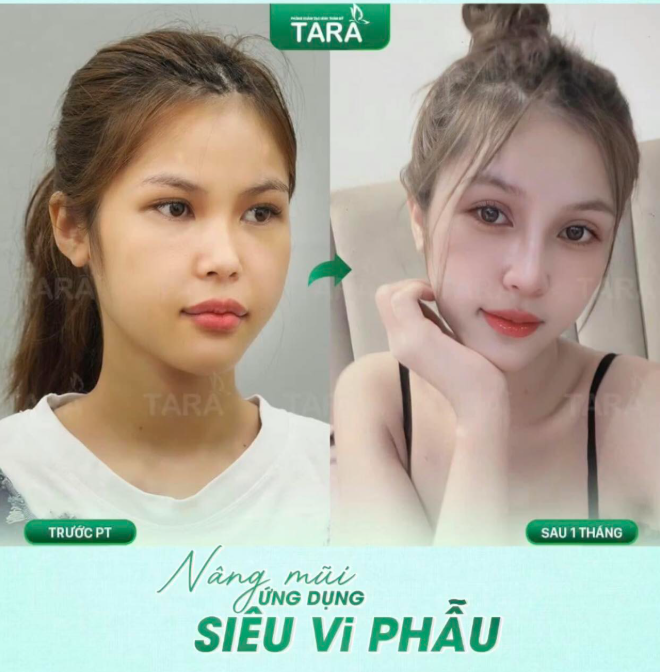 Nâng mũi siêu vi phẫu: 7 lầm tưởng và sự thật thú vị