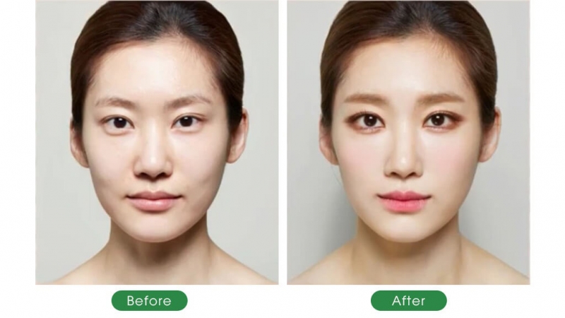 Cấy mỡ mặt làm đầy má hõm: Bí Quyết cho gương mặt đầy đặn