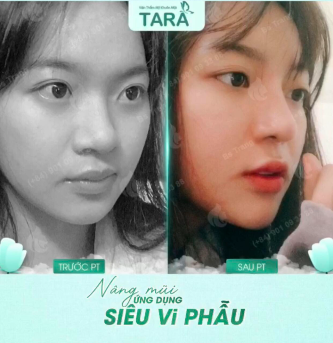Nâng mũi siêu vi phẫu cho người có da mũi mỏng: Cần lưu ý gì?