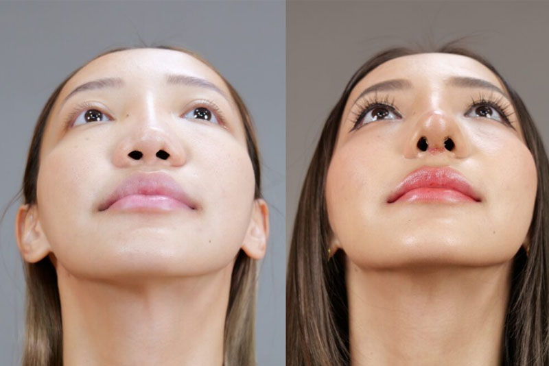Nâng mũi siêu vi phẫu cho người có da mũi mỏng: Cần lưu ý gì?