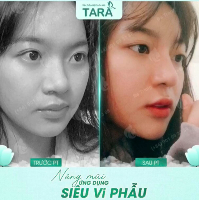 Vai trò của kính lúp trong nâng mũi siêu vi phẫu: "mắt thần" kiến tạo dáng mũi hoàn hảo  