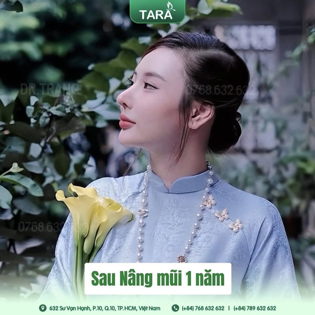 Nâng mũi siêu vi phẫu cấu trúc: Kiến tạo hoàn hảo dáng mũi  