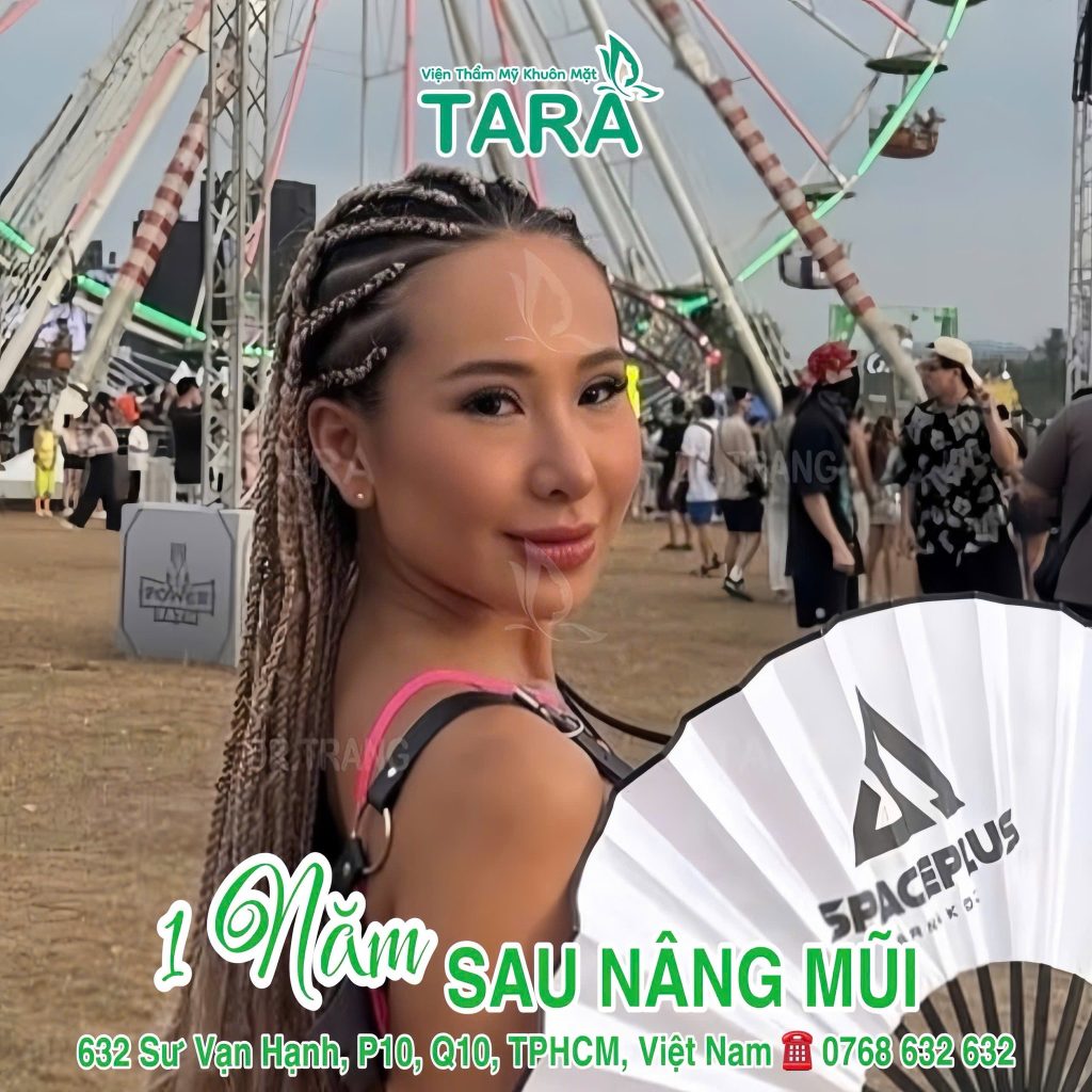 Nâng mũi siêu vi phẫu thu gọn mũi đầu to: Kiến tạo dáng mũi "tỷ lệ vàng"  