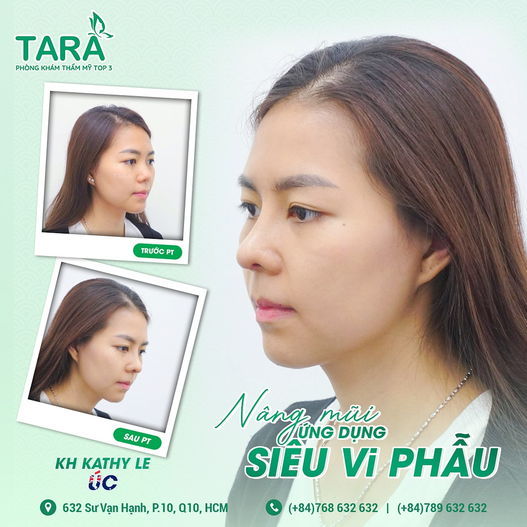 Nâng mũi siêu vi phẫu Surgiform: Kiến tạo dáng mũi tự nhiên hoàn hảo 