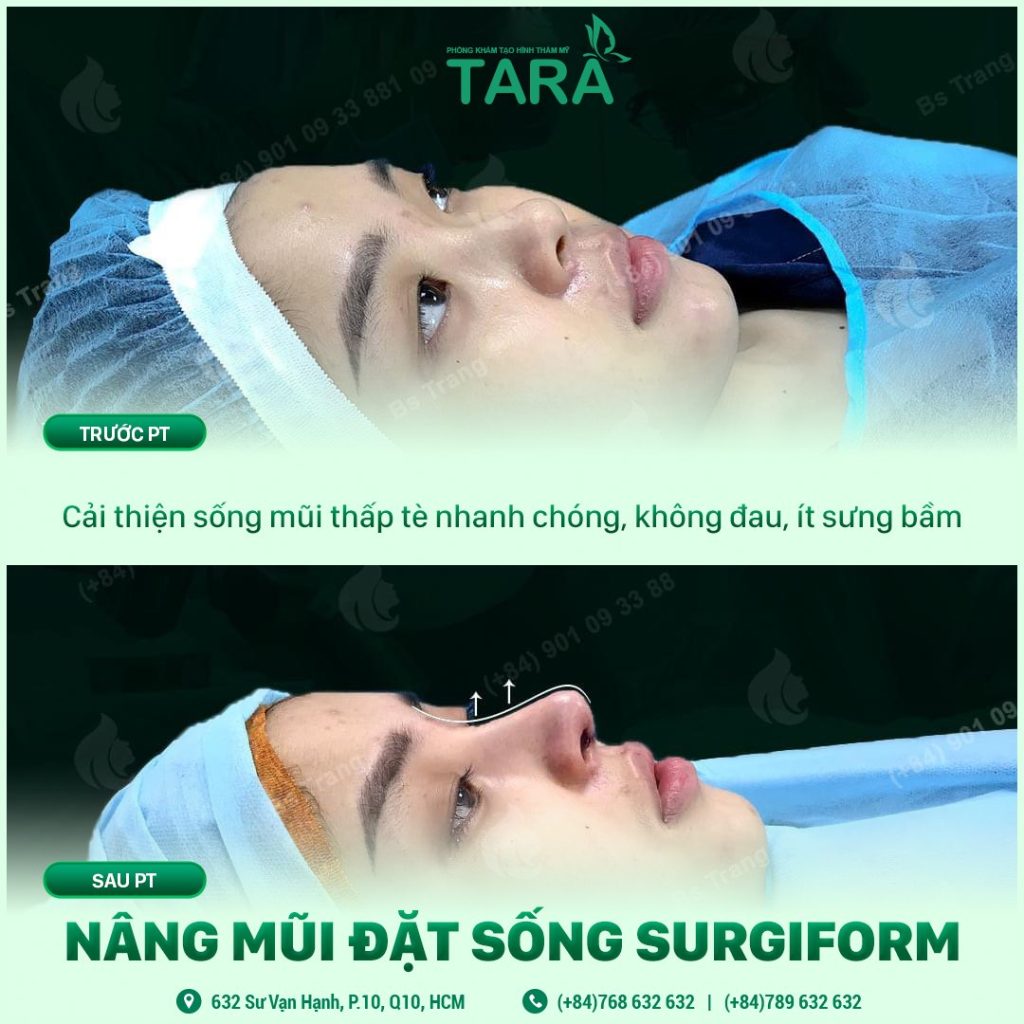 Nâng mũi siêu vi phẫu Surgiform: kiến tạo dáng mũi tự nhiên hoàn hảo 