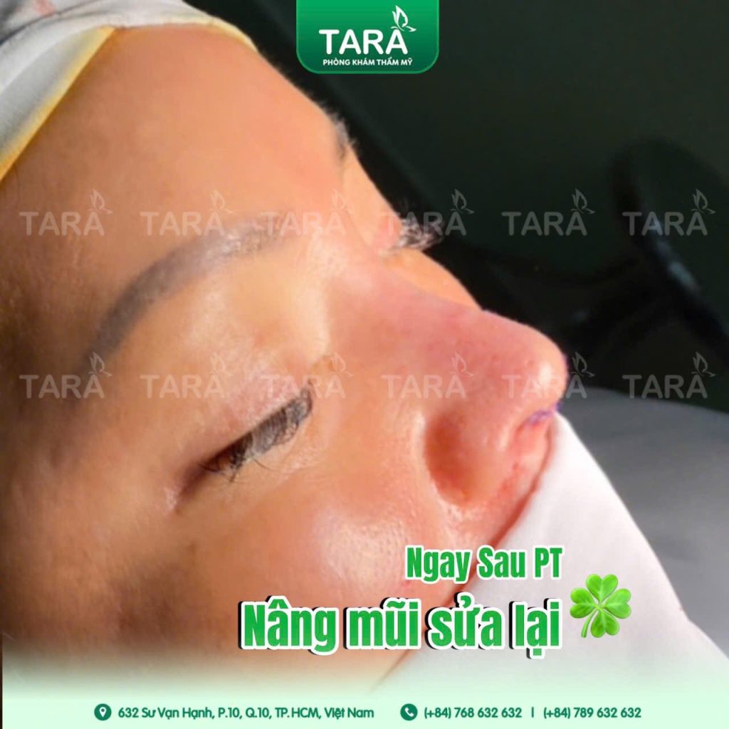 Quy trình sửa mũi hỏng siêu vi phẫu chuẩn y khoa