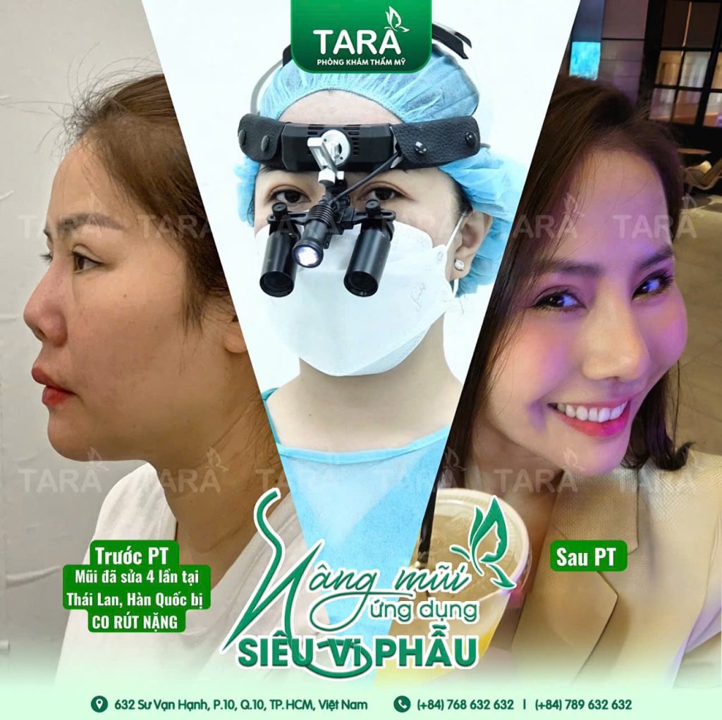Sửa mũi hỏng siêu vi phẫu: Giải pháp tái tạo mũi tự nhiên & an toàn