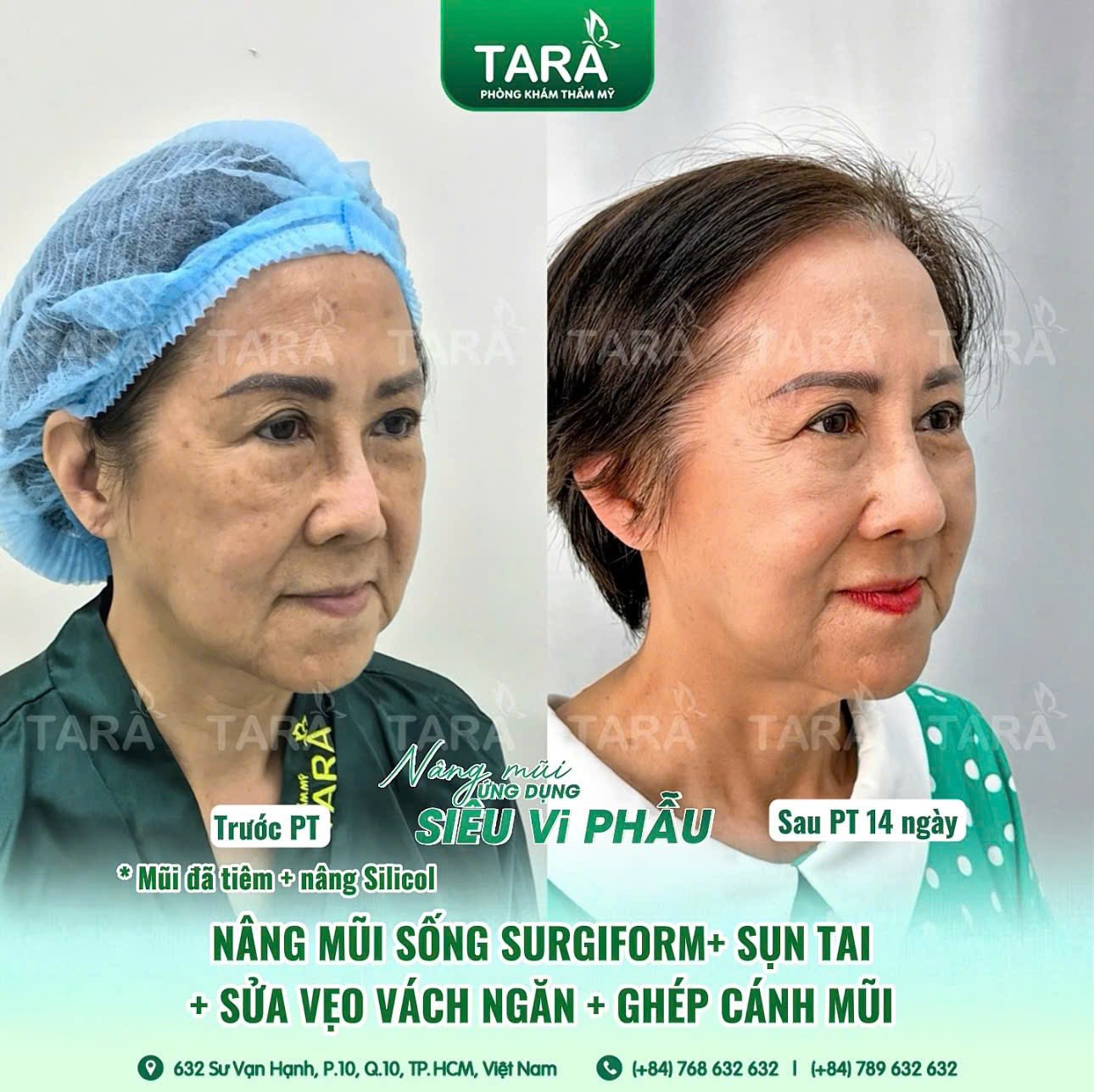 Lệch vẹo, co rút, nhiễm trùng: Dấu hiệu nguy hiểm sau nâng mũi