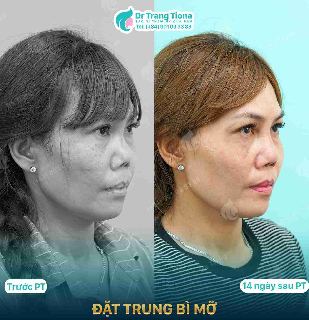Trung bì mỡ: "vật liệu vàng"  trong sửa mũi hỏng  