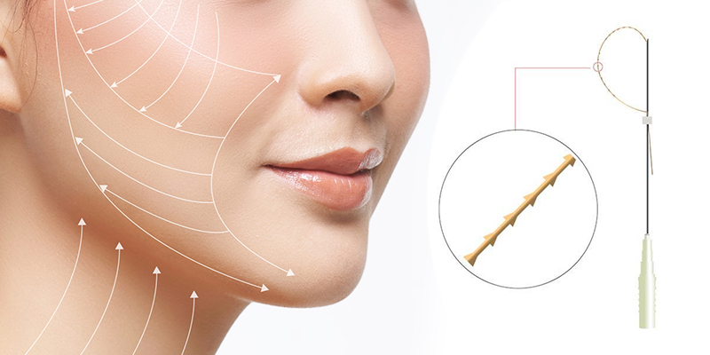 5 kỹ thuật căng da mặt phổ biến hiện nay: Đâu là giải pháp tối ưu?