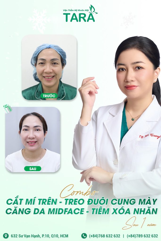 5 kỹ thuật căng da mặt phổ biến hiện nay: Đâu là giải pháp tối ưu?