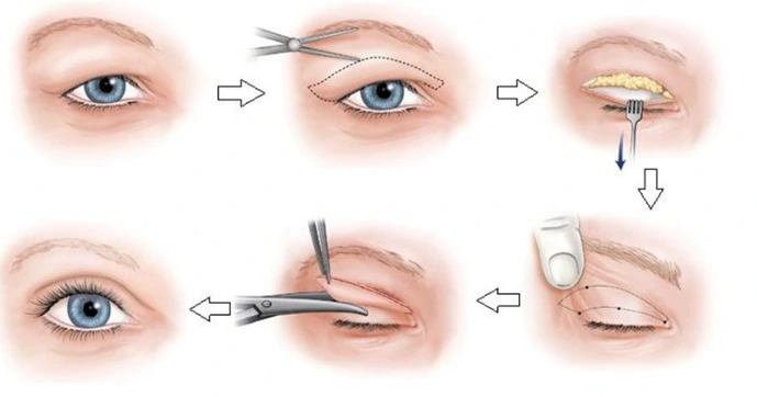 Cắt mí hay nhấn mí? Đâu là lựa chọn tối ưu?