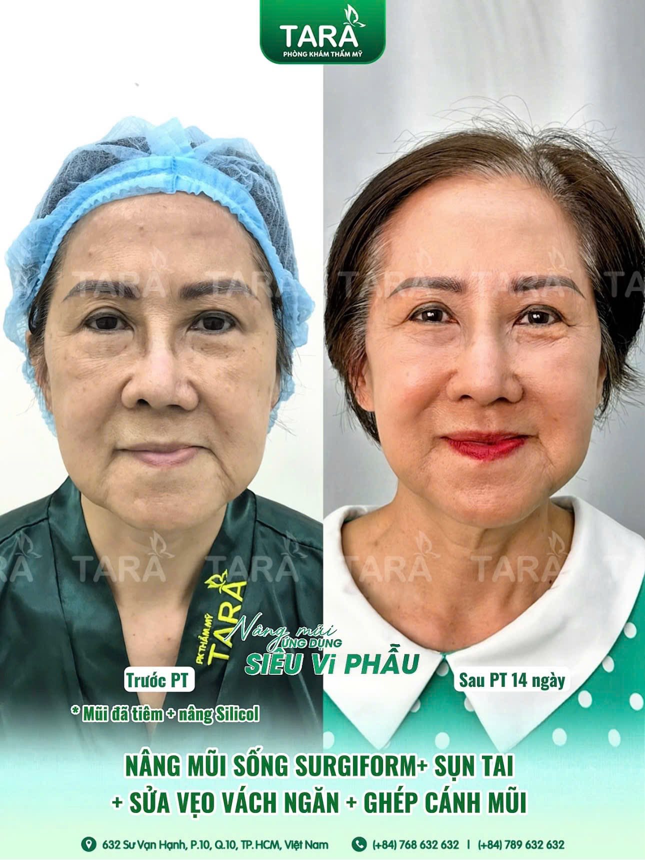 Nâng mũi siêu vi phẫu cho người lớn tuổi
