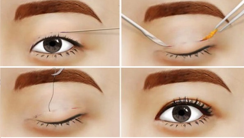 Cắt mí hay nhấn mí? Đâu là lựa chọn tối ưu?