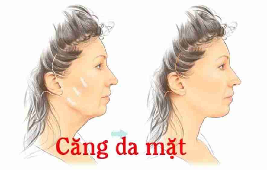Xóa bỏ nọng cằm, vùng hàm chảy xệ bằng căng da mặt