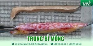 Địa chỉ sửa mũi hỏng siêu vi phẫu bằng trung bì mỡ TPHCM