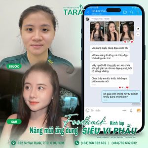 Kinh nghiệm chọn bác sĩ nâng mũi siêu vi phẫu giỏi tại TP.HCM