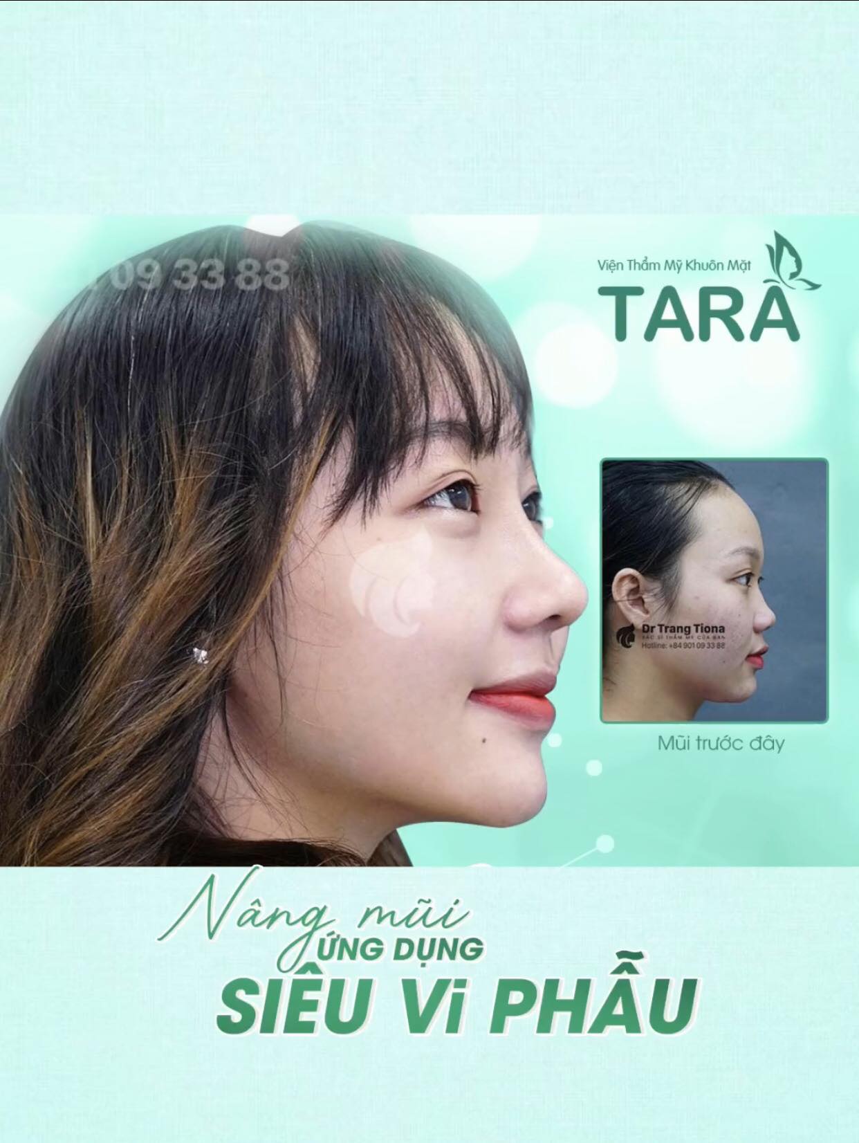Kinh nghiệm chọn bác sĩ nâng mũi siêu vi phẫu giỏi tại TP.HCM