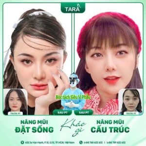 Nâng mũi tự nhiên không bị đơ từ kỹ thuật siêu vi phẫu hiện đại
